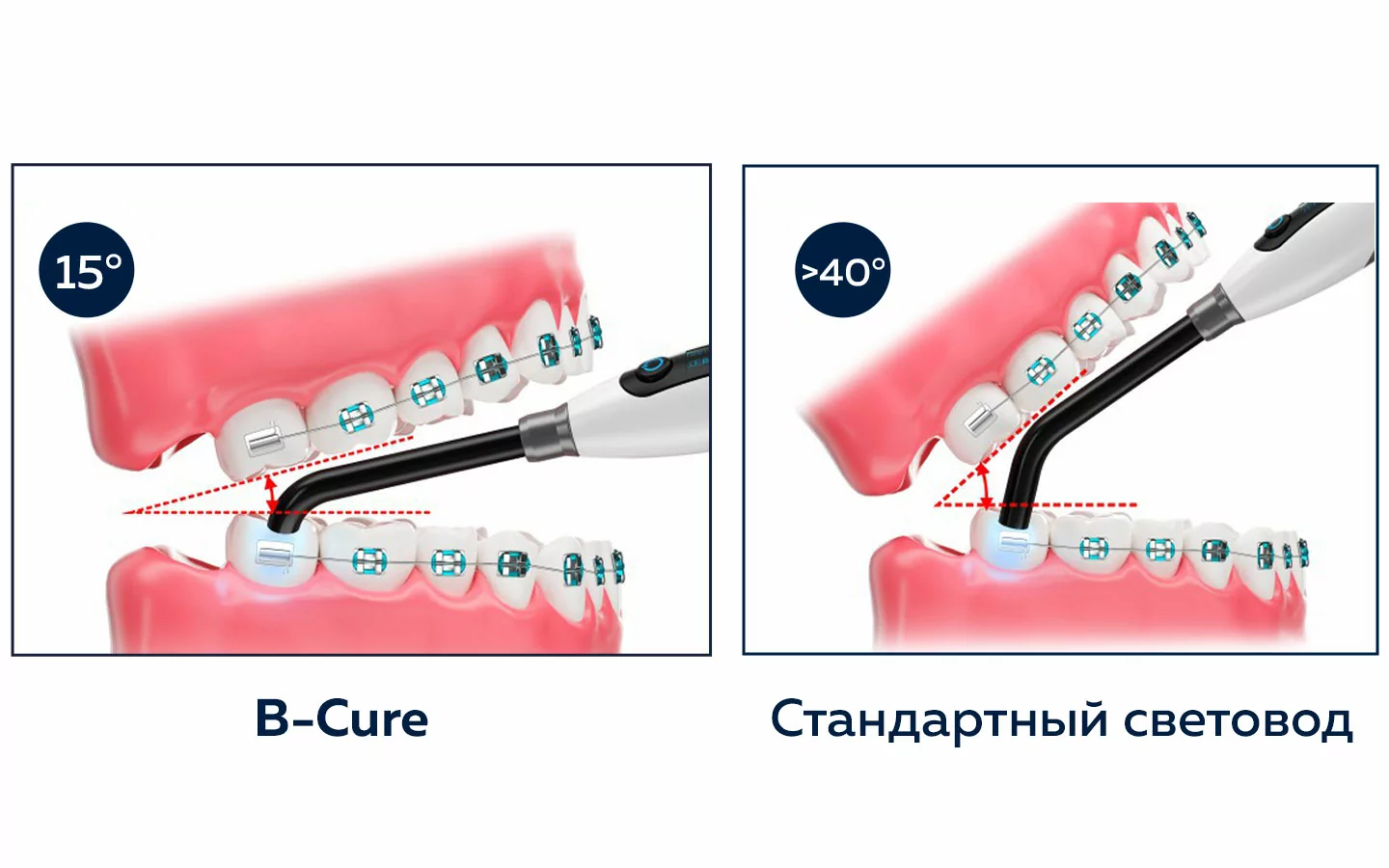 Применение эргономичного световода B-Cure в полости рта